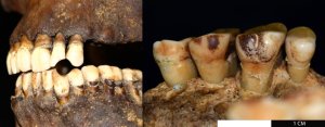 Left: Teeth of an individual with a 
clear round hole caused by holding 
a clay pipe. Right: Lingual staining 
on inner surfaces of teeth from using 
a tobacco pipe. Images: Tobacco, 
Health and History Project/UoL